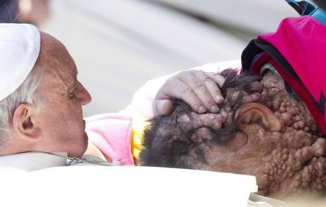 Pope Francis embracing man disfigured by disease 